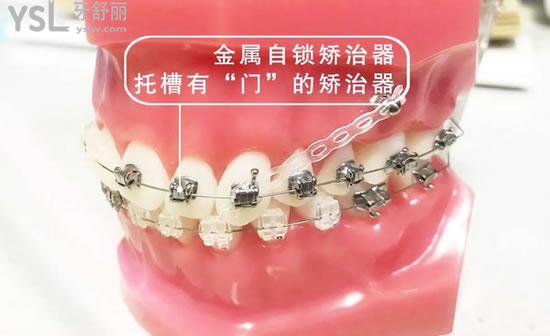 牙套的種類和價格曝光，精選剖析牙套哪種材料的比較好?