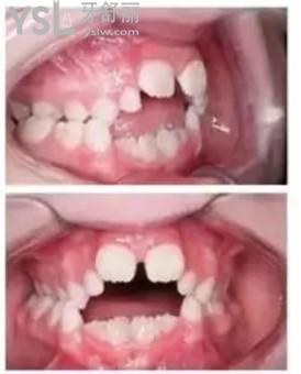 兒童牙齒畸形圖