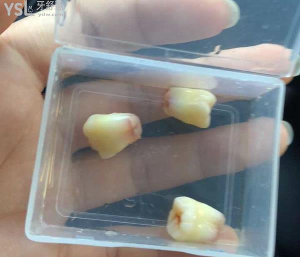 拔智齒后悔死了是真的嗎，拔智齒會很疼嗎？