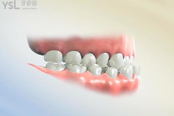 曉萌牙講座016章：揭開帶了牙套三年反彈了真相 (2).jpg