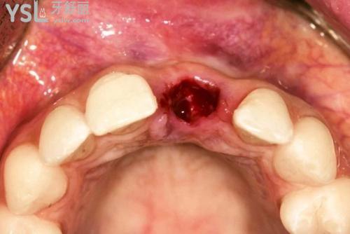 典型干槽癥圖片早期癥狀，拔完智齒后傷口發(fā)白算是干槽癥嗎？