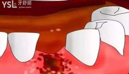 典型干槽癥圖片早期癥狀，拔完智齒后傷口發(fā)白算是干槽癥嗎？