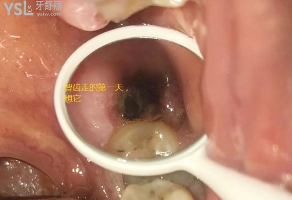 天涯咫齒第十四話：帶來拔牙后窟窿圖 (2).jpg