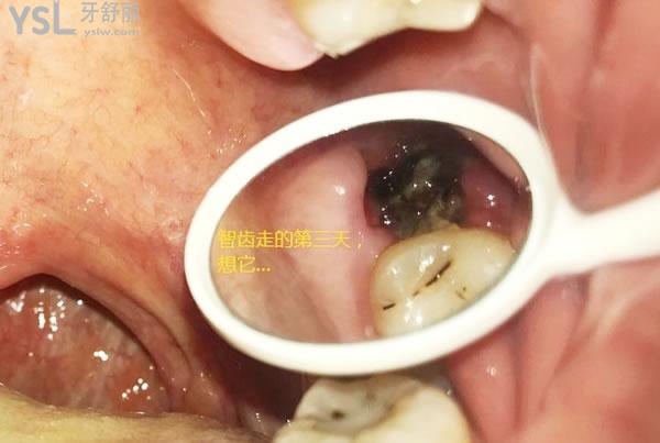 天涯咫齒第十四話：帶來拔牙后窟窿圖 (3).jpg