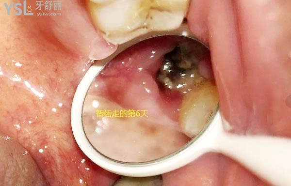 天涯咫齒第十四話：帶來拔牙后窟窿圖 (4).jpg