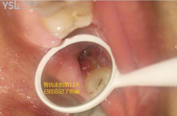 天涯咫齒第十四話：帶來拔牙后窟窿圖 (5).jpg