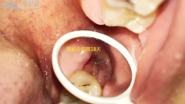 天涯咫齒第十四話：帶來拔牙后窟窿圖 (6).jpg