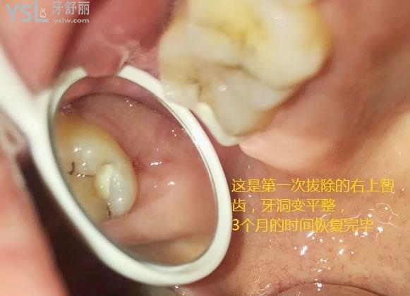 天涯咫齒第十四話：帶來拔牙后窟窿圖 (7).jpg