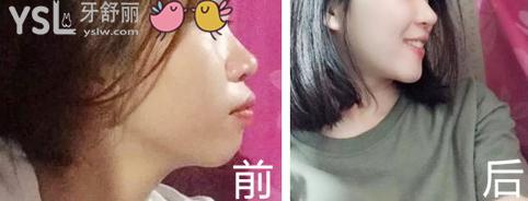 曉萌牙講座018章：帶來(lái)帶牙套1~12月變化圖 (8).jpg