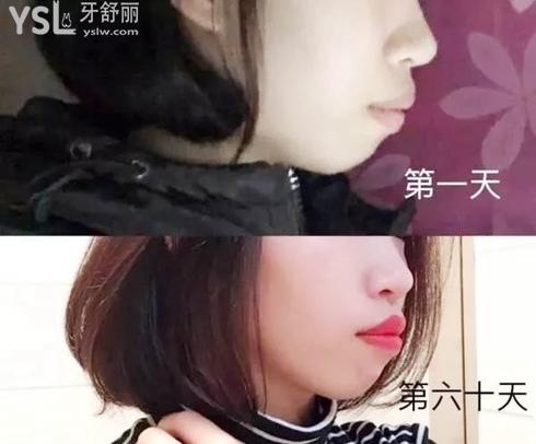 曉萌牙講座018章：帶來帶牙套1~12月變化圖 (3).jpg