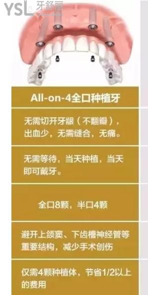 ALL-on-4種植技術(shù)優(yōu)勢