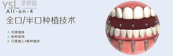 ALL-on-4種植技術(shù)