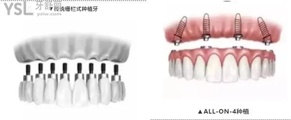 All-on-4種植技術