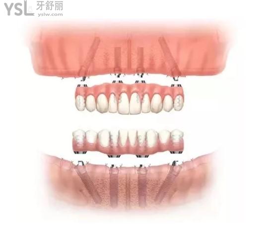 All-on-4全口種植