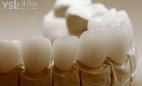全瓷牙