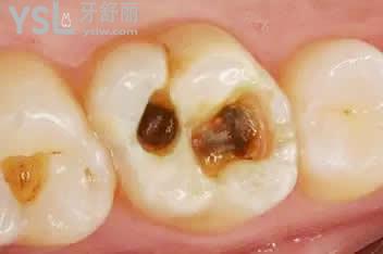 爛牙根2