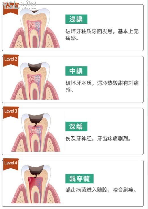 齲齒圖