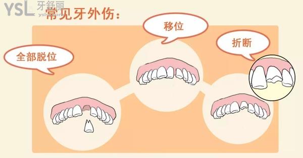 常見牙外傷