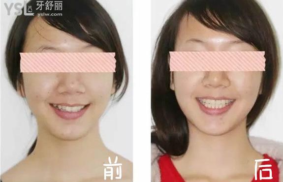 擴(kuò)牙弓前后臉型對(duì)照?qǐng)D