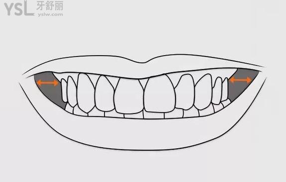 齒頰間隙示意圖