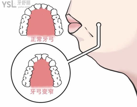 擴(kuò)弓會(huì)不會(huì)讓臉變大？