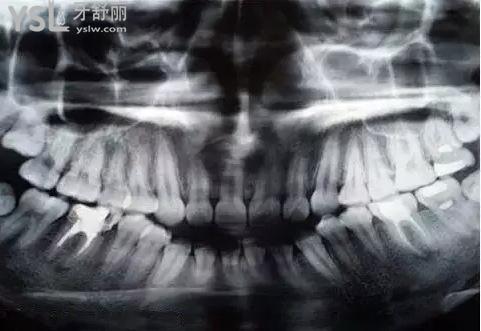 牙齒拍片