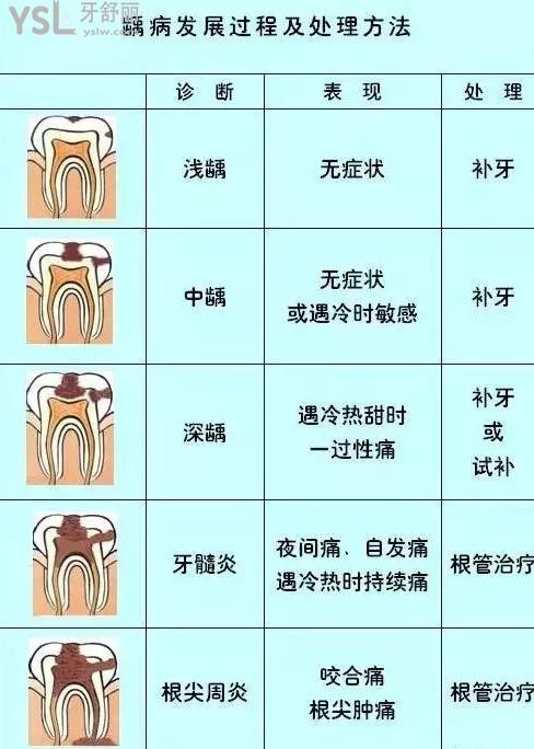 怎么判斷用不用根管治療示意圖