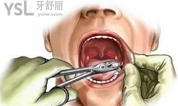 拔牙