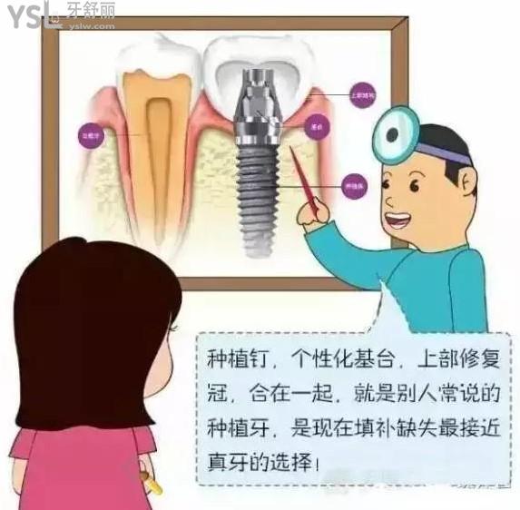 種植牙接近于真牙