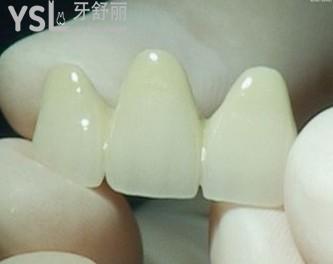 愛爾創(chuàng)全瓷牙