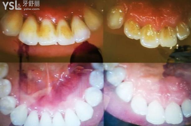 銀川諾貝爾口腔顧客洗牙前后對比