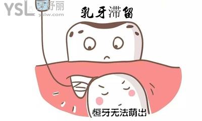 乳牙滯留