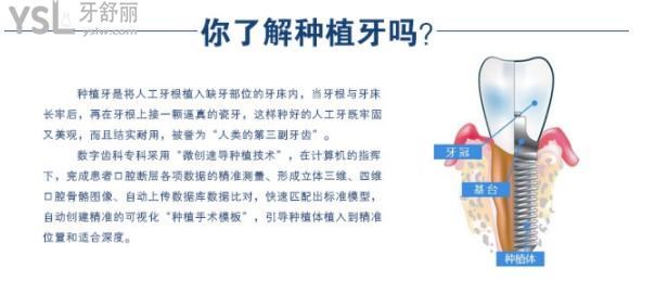 種植體介紹