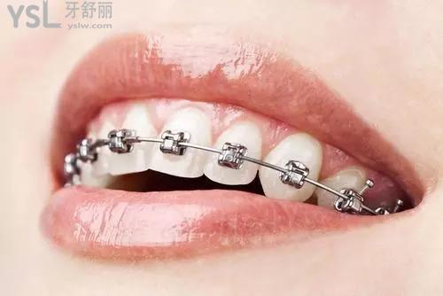 牙齒矯正圖