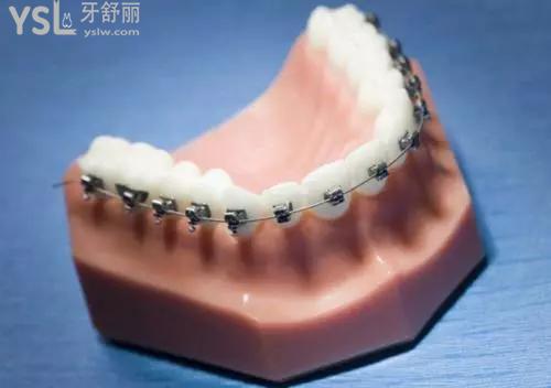 牙齒矯正圖