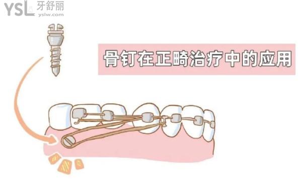 骨釘在正畸治療中的應(yīng)用