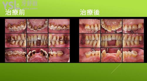 牙周炎治療成效