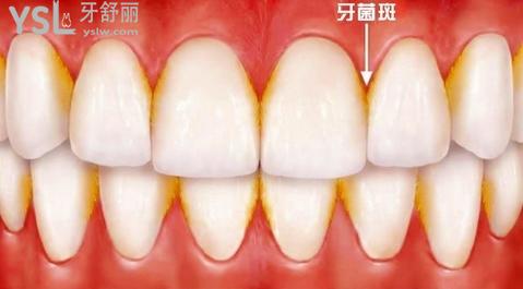 牙周炎應(yīng)該如何治療呢?