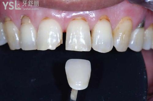牙齒貼面一定要磨牙嗎？非也