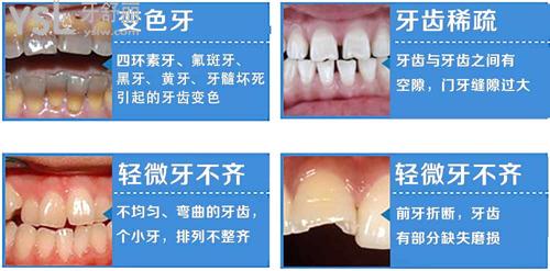 牙齒貼面適應癥