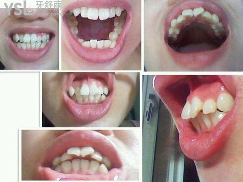 門(mén)牙兩顆齙牙配圖1