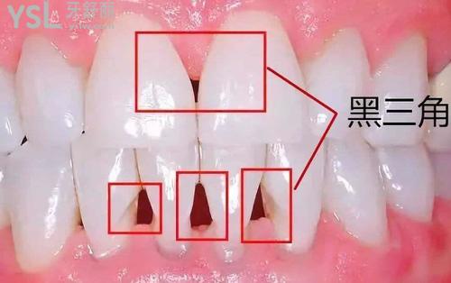 牙周炎牙齦萎縮1