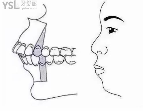 天包地要怎么矯正1