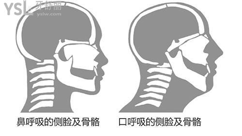 揭秘凸嘴怎么自己矯正