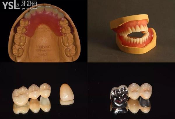 都2021年了，還不知道假牙安固定的還是活動(dòng)的好？
