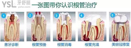 根管治療過程