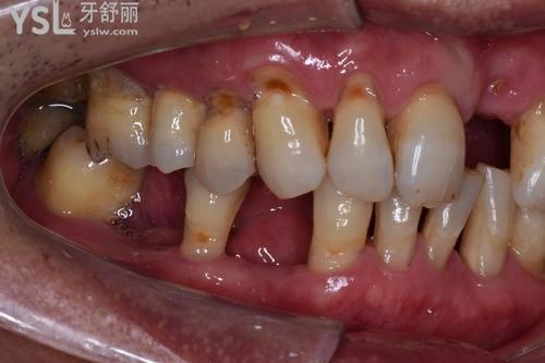 長期缺牙危害