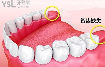 拔完智齒多久可以懷孕
