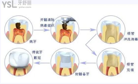 根管治療的過程