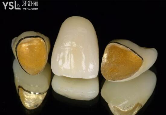 烤瓷牙套